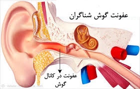 عفونت گوش شناگران 